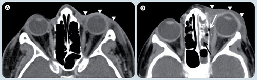 Figure 7. Orbital inflammatory disease.(A) Axial postcontrast soft tissue window CT image at the level of the orbits demonstrates diffuse thickening of soft tissues in the left preseptal region (white arrowheads). The postseptal region is normal. These signs together with the classical clinical history are diagnostic for preseptal cellulitis. (B) Axial postcontrast soft tissue window CT image in a different patient shows the diffuse thickening of soft tissues in left preseptal region (white arrowheads) extending to sclera, which enhances and is also thickened. A fusiform fluid collection (white asterisk) is depicted in the extraconal space, between the medial rectus muscle and the lamina papiracea with an air bubble (white arrow). The findings are compatible with an abscess. There is fluid in the ipsilateral ethmoid cells compatible with sinusitis (black arrow), which is the likely origin of the abscess.
