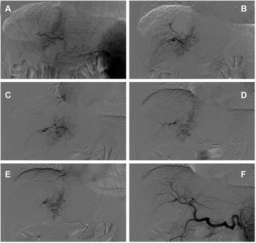 Figure 4 Celiac arteriogram demonstrates the hypervascular mass but does not provide much assistance in determining the number and location of feeding vessels to the target (A). Subselective arteriogram with a microcatheter clearly demonstrates the suitable target vessels to treat this tumor (B–E). Celiac arteriogram shows no tumor staining after DEB-TACE treatment with CalliSpheres microsphere (F).