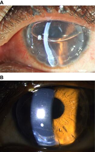 Figure 5 (A) Slit lamp photo three days after surgery of one case with large inferior Descemet’s membrane tear showing a detachment. (B) Same eye 18 months after surgery showing the large Descemet’s membrane break with clear stromal tissue and interface.
