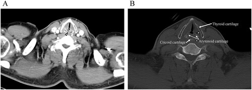Figure 2. Computed tomography findings. (A) An abscess is in the posterior glottic region (arrowhead). (B) A portion of the left arytenoid cartilage has disappeared (arrowhead).