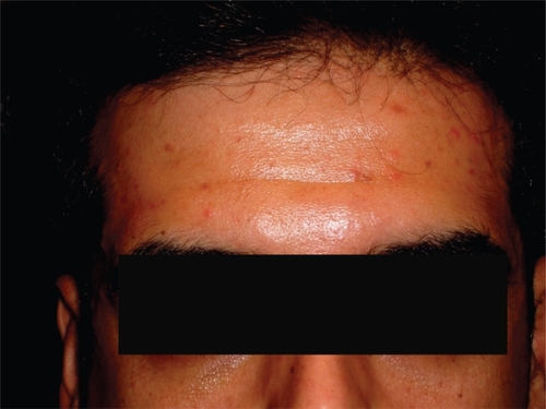 Figure 1 The maculopapular rash on the patient’s forehead.
