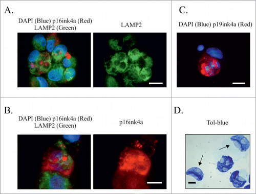 Figure 9. The relationship between autophagy functionality and senescence marker p16ink4ain ETO-treated PA-1 cells. PA-1 cells were treated with 8 µM ETO for 20 h without or with Baf, prior to media being removed and replaced with fresh media; cells were harvested 48h later (day 4). (A, B) imunofluorescent staining for p16ink4a (red), LAMP2 (green) or DAPI (blue). (A) As shown via the BRG optical filter, (B) only the green filter for LAMP2 demonstrating high level of functional autophagy sequestrating p16ink4a- containing aggresomes. (B, C) show examples of autophagic failure, where on (B) sequestration of p16ink4a is partly lost, diffusing in to the cytoplasm, while on (C) the dysfunction of autophagy is evidenced by a large vacuole overloaded with undigested p16ink4a. In all 3 cases, the nuclei are impaired: (B) ‘laced’; (C) displaced and twisted by a large autophagic vacuole with some DNA lost from cell nucleus observed. These processes were observed both in ETO-treated (B) and more commonly in ETO+BAF(c) treated cells. (D) An image showing cell nuclei of normal and sickle-type shape as stained specifically for DNA with Toluidine bluein the ETO-teated specimen (sickle-like shaped nuclei are shown with arrows).