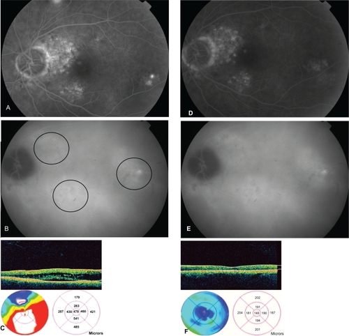 Figure 1 A) Fluorescein angiography (FA) shows multiple focal areas of hyperfluorescence with underlying retinal pigment epithelium (RPE) window defect involving the macula and the peripapillary region before transpupillary thermotherapy (TTT). B) Indocyanine green angiography (ICGA) showing multiple irregular patches of hyperfluorescence before TTT. Black circles indicate the area covered by large-spot subthreshold TTT. C) Optical coherence tomography (OCT) image of line scan through the macula showing macular neurosensory detachment with cystoid macular changes. D) FA showing slow, indistinct staining with absence of active focal leakage after TTT. E) ICGA showing choroidal patch of hyperfluorescence without significant vascular effects, dark zone, or perfusion defects in the choriocapillaris. OCT image showing resolution of the serous detachment and cystoid macular edema after treatment. F) No RPE atrophy or retinal scars were observed in the area covered by the laser spot during the follow-up.