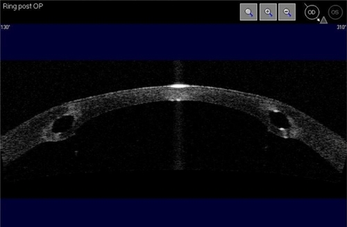 Figure 6 Patient 2: Corneal imaging using Visante™ OCT after one week of Intacs SK implantation.