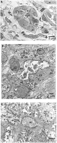 Figure 3 Electron microscopic findings. (A) Degenerative bile duct-related epithelial cells (arrowhead) are in an apoptotic process, as inferred from the appearance of condensed polymorphic and fragmented nuclei. The intercellular space adjacent to this degenerative epithelium is remarkably dilated (arrow), implying that bile substances are regurgitated from the lumen to the abluminal side. (B) A canal of Hering (CoH) with markedly dilated lumen (L) and loss of microvilli is lined by two hepatocytes (H1 and H2) and four cholangiocytes (C1–C4) containing deposits of electron-dense biliary substances (arrowhead). The intercellular space adjacent to epithelium is dilated (arrow). Between the two hepatocytes (H1 and H2) is a remarkably dilated bile canaliculus (BC) showing complete loss of microvilli and heavy deposition of biliary substances (arrow). (C) This electron micrograph shows a pseudo-bile ductule, the lumen of which is lined by six hepatocytes containing bile substances. The adjacent bile canaliculus (BC) is dilated with loss of microvilli and deposit of bile substances. The arrow indicates deposition of biliary substances.