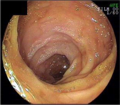 Fig. 1 Endoscopic appearance of normal terminal ileum.