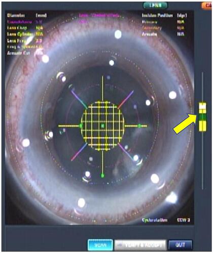 Figure 1 View of the patient interface. The vacuum-level gauge is within normal limits (yellow arrow).