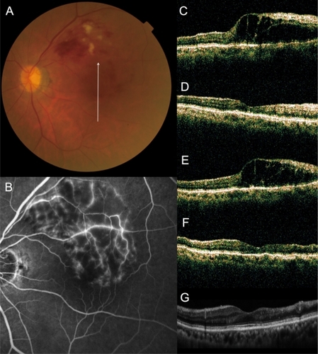 Figure 3 No recurrence of macular edema after grid photocoagulation combined with intravitreal bevacizumab (IVB) for recurrent macular edema associated with branch retinal vein occlusion. (A) An 83-year-old woman had a visual disturbance in the left eye (0.3 OS) due to macular edema associated with branch retinal vein occlusion. (B) Fluorescein angiogram shows fluorescein leakage from the capillaries. (C–G), Vertical sectional images centered on the fovea with optical coherence tomography were obtained at the initial visit (C), at 1 month after the initial IVB (D), just before the combined therapy (at baseline, E), at 1 month after combined therapy (F), and at the final visit (G). She had no recurrence after the combination therapy (0.8 OS).