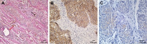 Figure 1 IHC of paraffin-embedded esophageal cancer. (A) Hematoxylin–eosin staining of VM channel on the left lined only by tumor cells which are negative for CD34 staining (red arrow). The panel on the right shows endothelium-dependent vessels are positive for CD34 staining (black arrow) (magnification: 200×). (B) E-cadherin expression in esophageal cancer (magnification: 200×). (C) CD66b expression in esophageal cancer (magnification: 400×).
