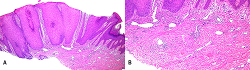 Figure 2 Histopathologic findings. (A) Prominent hyperkeratosis, parakeratosis and irregular hyperplasia in the epidermis (Hematoxylin and eosin; x 40). (B) Mild lymphocytic infiltration in the dermis (Hematoxylin and eosin; x 100).