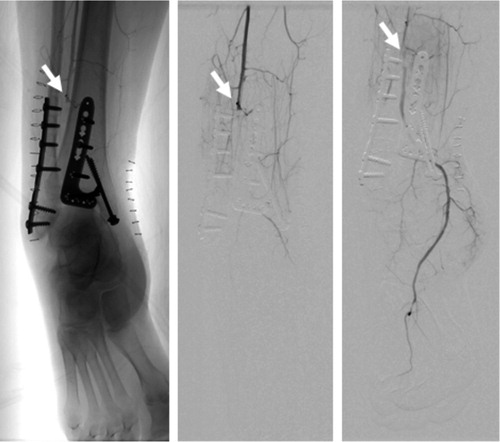 Figure 3. Angiography showing occlusion of the peroneal artery at the level of the tip of the posterior plate (white arrows). Despite efforts to dissolve the occlusion with catheter-directed thrombolysis, the artery kept clotting.