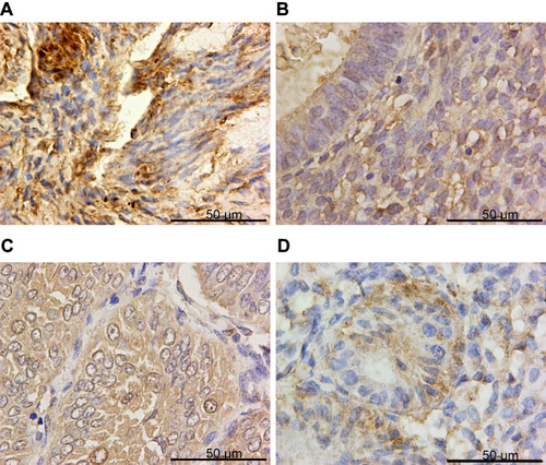 Figure 2 GPX4 was down-regulated in endometrial cancer specimens. Representative images of GPX4 immunohistochemistry staining in (A) CON, (B) SEH, (C) AEH and (D) EC specimens.