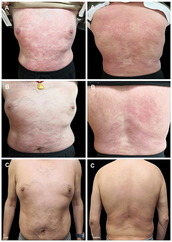 Figure 3 Etanercept treatment photographs. (A) At the beginning of etanercept treatment (The patient’s trunk has large areas of erythema, plaque, and tiny scales), (B) at the third week of etanercept treatment (Erythema area decreases and color fades), and (C) at the 21st week of etanercept treatment (The patient has a small area of pale erythema on his back).