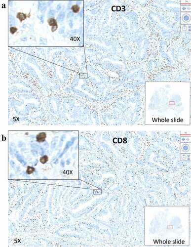 Figure 1. Representative images of CD3 and CD8 staining. Whole tumor slides of patients with stage II CRC from SYSUCC cancer center were stained for CD3 (A) and for CD8 (B). Whole slide images, 5X magnification and 40X magnification are illustrated.