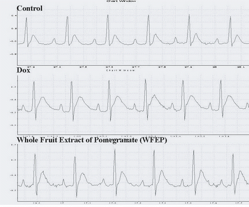 Figure 3.  ECG pattern showing the difference in QT and ST intervals in three study groups.