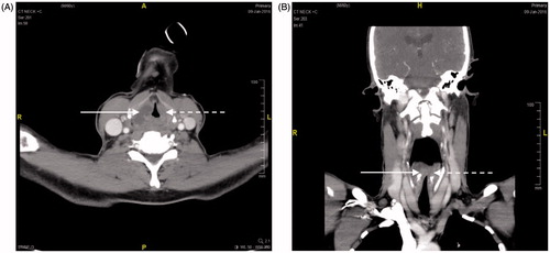 Figure 1. Axial and coronal cut sections of bilateral false vocal cords hypodense rim enhancing lesions: right false vocal cord 2.2 (anterior–posterior) × 1.8 (width) × 2.4 (height) cm (in solid arrow) and left false vocal cord 1.3 (anterior–posterior) × 0.5 (width) × 0.9 (height) cm (in broken arrow).