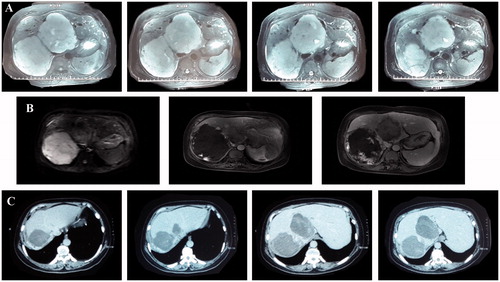 Figure 3. A 37-year-old male with two giant hepatic hemangiomas of 12.5 and 11.7 cm in diameter. (A) Preoperative MRI (size: 12.5 cm × 10.0 cm, 11.7 cm × 9.3 cm). (B) MRI after the first ablation (size: 7.5 cm ×6.2 cm). (C) MRI after the second ablation (size: 7.1 cm × 6.4 cm).