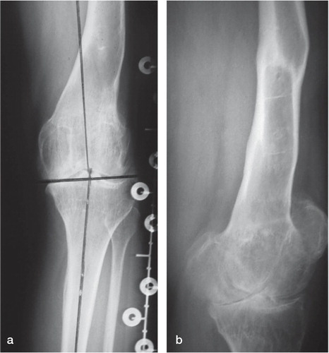 Figure 2. Standing weightbearing radiographs of the left leg in a 36-year-old patient, who at the age of 14 sustained a distal femoral shaft fracture, which was treated with tibial skeletal traction. AP (a) and lateral view (b) show severe degenerative (grade-II) changes in the tibiofemoral joint.