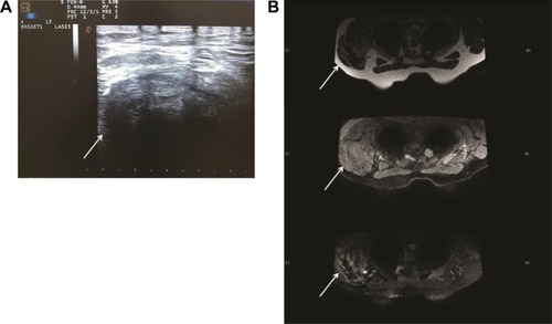 Figure 2 Imaging of ultrasound and MRI examination of breast.