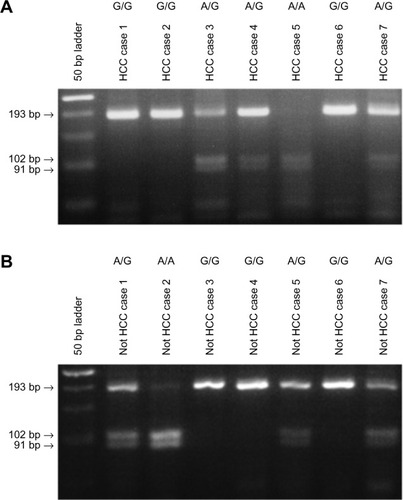 Figure 1 EGF SNP was analyzed by using restriction fragment-length polymorphism, and the representative results are shown: (A) HCC patients and (B) not HCC patients with liver disease other than HCC, including hepatitis or cirrhosis patients.