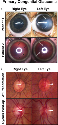 Figure 1. Primary congenital glaucoma (PCG). (a) Two patients with PCG show buphthalmos and varying degrees of corneal edema (white arrows). Patient 2 also has a backwards ‘C’ shaped haabs striae (black arrows). (b) Optic nerve photographs of a patient with PCG at presentation (top row) and 4 years after obtaining IOP control from angle surgery (bottom row) show reversal of cupping (white arrowheads) especially in the left eye.