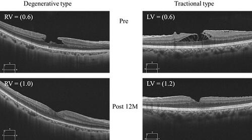Figure 1 Typical preoperative and postoperative optical coherence tomography images for the two types of lamellar macular holes.