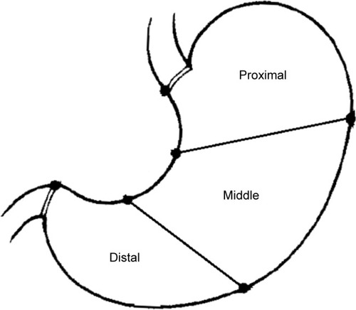 Figure 1 The location of gastric cancers. The stomach is divided into three parts including the upper third (proximal), middle third, and lower third (distal), according to JGCA Classification of Gastric Carcinoma.