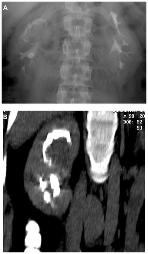 Figure 6 Right pelvicaliceal tumor. (A) Intravenous urography shows localized upper hydrocalycosis with filling defect inside. (B) Computed tomography urography shows soft tissue mass inside the upper calyx.