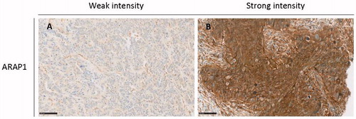 Figure 2. Staining intensity for ARAP1 correlates with time to progression. Immunohistochemistry showing weak and strong intensity of ARAP1 staining, respectively, in HGSC samples. (A) Weak intensity. Example from the early progression group. (B) Strong intensity. Example from the late progression group. Scale bar: 100 µm.