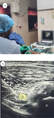 Figure 2 Sciatic and Posterior femoral cutaneous nerve Blocks. (a) non-physician anesthetist performing transgluteal approach to sciatic and PFCN nerve block. (b) Sono-anatomy of transgluteal approach for the sciatic nerve and PFCN blocks.