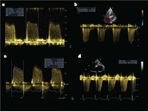 Figure 1. Increasing transmitral gradients (a-c) and tricuspid peak velocity (related directly to PA systolic pressure) (B & D) during exercise stress echocardiography.