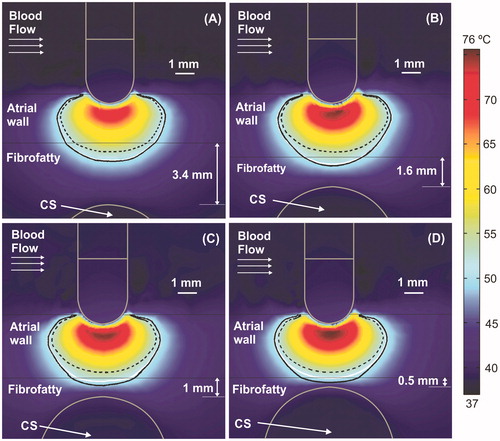 Figure 3. Temperature distributions (scale in °C) at 15 s with the electrode in perpendicular position for four arrangements: (A) typical case with 2.7 mm atrial wall (AW) and 3.4 mm distance from AW to CS (AW-CS distance); (B) 3.4 mm AW and 1.6 mm AW-CS distance; (C) 3.4 mm AW and 1 mm AW-CS distance; (D) 3.4 mm AW and 0.5 mm AW-CS distance. Lines represent the thermal lesion contours for the cases without occlusion (solid white line), with distal occlusion (solid black line), and with proximal occlusion (dashed black line), i.e., with the 40 mm balloon just below the electrode.