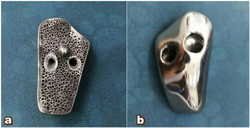 Figure 5. 3D printed finished product. (a) processing of porous talus and leg into the remained talus and establishment of the fixation screw channel; (b) bright polishing of articular facet of the talus prothesis.