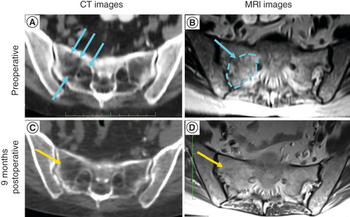 Figure 2. CT and MRI imaging study of the right sacrum.(A) CT imaging showing the defect created by the tumor (blue arrows). The scalloped appearance of bone is associated with bone lysis/destruction adjacent to regions of sclerotic bone. (B) T2 STIR MRI image with gadolinium contrast showing the tumor located in the sacrum defect (blue arrow and dashed line). (C) CT image showing the resolution of the defect (yellow arrow). (D) T2 STIR MRI with gadolinium contrast showing that there is no tumor in the treated defect (yellow arrow). STIR: Short tau inversion recovery.CT: Computed tomography.