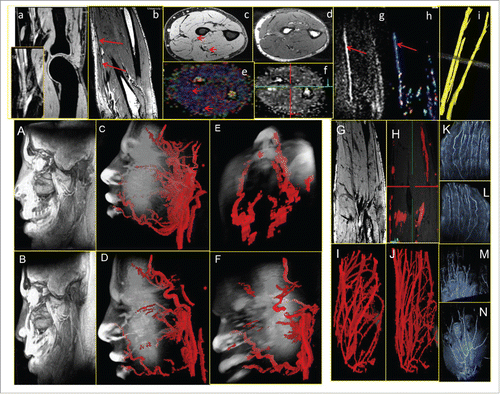 Figure 1. [a]: T1W image showing nreve branching after Brachial bifurcation, [b]: T2W image showing radial nerve along the forearm, [c,d]: Axial T1W AND T2W images for Diffusion imaging, [e,f]: Color coded and FA map (sagittal view of forearm), [g]: Fiber tractography for forearm nreves (and it's branches); [A,B]: 3D construction of VBIE fat-sat (nerve and vessel visualization), [C,D,E,F]: Vessel segmentation (lateral nasal, Superior labial, Inferior labial, facial, Transverse artery, Ophtalmic artery, Superficial temporal artery, External carotid); [G]: SWI Forearm image showing vasculature, [H]: Masked vasculature, [I,J]: Vessel segmentation in forearm arteries and veins. [K,L]: Digital vessels in fingers, [M,N]: 3D volume texturing Super Palmer Arch in the palmer region.