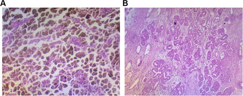 Figure 4 (A) Post operative histopathology from right nasal cavity. (B) Histopathology from right maxillary sinus.