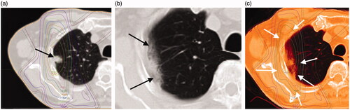 Figure 2. (a) An 84-year-old man with a 14-mm-diameter adenocarcinoma in the right upper lobe S2 of the lung (black arrow). (b) This shadow appeared as a "Scar-like pattern" in late phase computed tomography (CT) imaging at 559 days after radiotherapy (black arrows). (c) Treatment planning and acute CT imaging were fused with MIM Maestro. The shadow of RILI was found in the 70% dose region (white arrows).