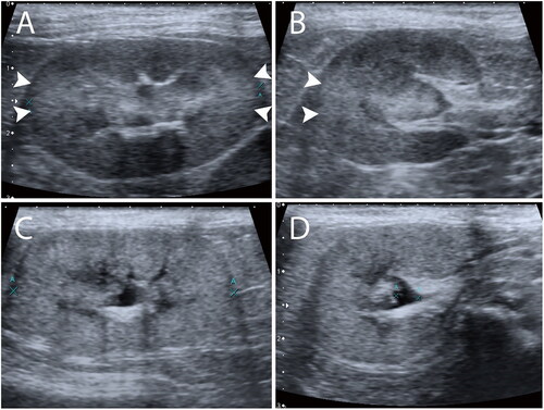 Figure 1. Presence of renal CABA in the longitudinal (A) and transverse (B) planes. Presence of a focally increased echogenicity cortex at the 3 and 9 o’clock of the renal cortex (arrow heads). Absence of renal CABA in the longitudinal (C) and transverse (D) planes.