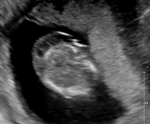 Figure 3 First-trimester septated fetal cystic hygroma in a 33 year-old, P2 at 11 and 5/7 weeks’ gestation. Non-invasive prenatal screening revealed increased risk of Trisomy 21. The patient declined amniocentesis, elected to continue her pregnancy and was delivered by repeat Cesarean at 35 and 5/7 weeks’ gestation following the diagnosis of fetal growth restriction (AC < 10th centile for gestational age) with reversed end diastolic flow in the umbilical artery. Birth weight was 2120 grams Apgar scores 9 and 9 at 1 and 5 minutes, respectively. UA pH = 7.23, BE = −1.1. Neonatal facial dysmorphic features were consistent with Trisomy 21, which was later confirmed by neonatal karyotyping.
