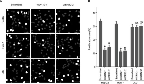 Figure 4 Knockdown of WDR12 expression decreases HCC cell proliferation.Notes: (A) Cells were infected with scrambled or WDR12 shRNAs for 72 hours, followed by analysis of cell proliferation by EdU and Hoechst 33342 labeling. Representative images. Bright white (EdU-labeled) indicates proliferating cells. (B) Proliferation rate. N=4; *P<0.005; NS, no significant difference, compared to the scrambled shRNA group. Scale bar 20μM.Abbreviations: EdU, 5-ethynyl-2′-deoxyuridine; HCC, hepatocellular carcinoma; WDR, WD-repeat protein.