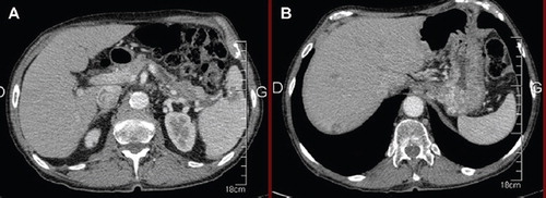 Figure 2. December 2010 CT-scan showing an objective response on primary tumor (A) and liver metastasis (B). CT, computed tomography.