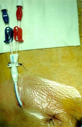 Figure 6 External abdomen location of cuffed tunneled central venous catheters in femoral vein, as a variant of the normal external leg location.