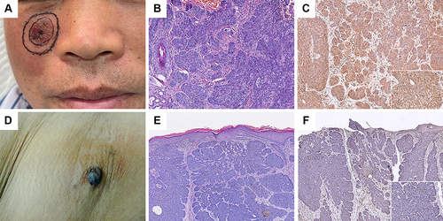 Figure 3 Gli1 expression at exposed and non-exposed sites. (A) Clinical and ((B); HE×100) histopathological picture of the BCC located on the face. (D) Clinical and ((E); HE×40) histopathological picture of the BCC in the axilla. Gli1 showed intense staining at exposed sites ((C); IHC×100), while it showed weaker staining at non-exposed sites ((F); IHC×40).