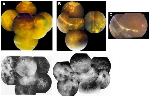 Figure 2 Color fundus photograph (upper panel), corresponding fluorescein angiography (lower) of the right eye in patient #2 with adult Coats’ disease. (A) At the initial visit; (B) 3 months after treatment of retinal photocoagulation and cryotherapy; (C) 10 years after treatment (FA image not available).