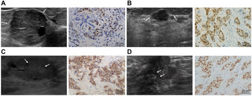 Figure 1 The ultrasonographic image and ER, PR, HER-2 and Ki-67 expression in breast cancer patients. (A) Burr-like edges of breast cancer mass (showed by white arrows), and ER-positive rate in breast cancer patients by immunohistochemical staining (400×). (B) Rich blood flow signal of breast cancer mass (showed by white arrows), and PR-positive rate in breast cancer patients immunohistochemical staining (400×). (C) Lymph node metastasis of breast cancer ultrasound imaging (showed by white arrows), and HER-2-positive rate in breast cancer patients immunohistochemical staining (400×). (D) Small calcifications of breast cancer mass (showed by white arrows), and Ki-67 high expression in breast cancer patients immunohistochemical staining (400×).
