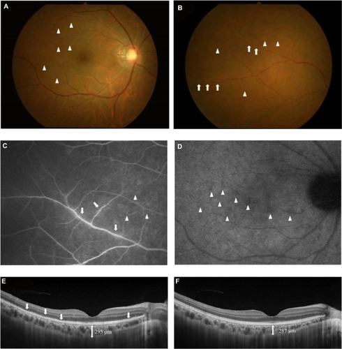 Figure 1 Photographs of the right eye in a patient with multiple evanescent white dot syndrome (Case 1) at the initial visit (A–E) and 3 months later (F).