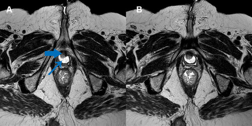 Figure 2 Magnetic resonance image of the pelvis.