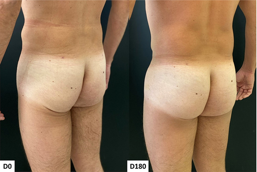 Figure 12 Case 6, Buttocks Beautification 3D. Standardized oblique images pre and 180 days post injection.