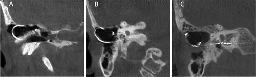 Figure 3 Computed tomography scans of patient 2 at day 2 post initial CI surgery (A), at 10 months post initial CI surgery at onset of symptoms (B) and after revision with fixation of the array and resolution of symptoms (C). The electrode array has worked itself out of the bony mastoid cavity borders (B) and was stably placed back into the cavity with a non-resorbable suture (C).