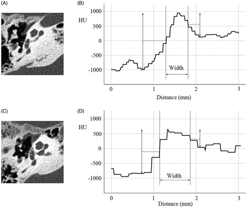 Figure 1. Measurement of stapes footplate thickness. (A) Normal control. Line in A represents a perpendicular line across the stapes footplate at the midpoint between the anterior and posterior crura. (B) Profile curve in A. Longitudinal axis shows HU value along the perpendicular line shown in A. Width was measured as representing stapes footplate thickness using the full width at half maximum (FWHM) method. (C) Otosclerosis patient. Line in C represents a perpendicular line across the stapes footplate at the midpoint between the anterior and posterior crura. (D) Profile curve in C. Longitudinal axis shows HU value along the perpendicular line shown in C. Width was measured using the FWHM method, resulting in much thicker width than in the normal control (B).